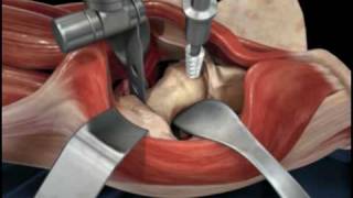 Direct Anterior Approach Hip Replacement [upl. by Vanzant210]