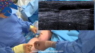 TRLOP closure of perforator veins in varicose vein surgery using NTD [upl. by Gagnon932]