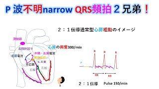 心電図：暗記からの卒業 124話 narrow QRS 頻拍1 P波不明 [upl. by Asilahs145]