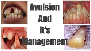 Avulsion  Avulsed tooth  Management  Treatment [upl. by Parsaye633]