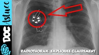 🔴 5 Dr Astuce  APPRENDS LE SYNDROME ALVEOLAIRE EN  DE 5 MIN  partie 1  Dr Astuce [upl. by Ahseuqal]