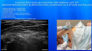 Ultrasound of Greater Trochanteric Bursitis Platelet Rich Plasma Injection in a 35 Year Old Female [upl. by Geralda]