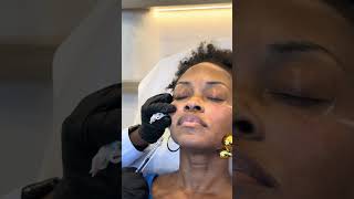 Facial Balancing by Galore Medical filler fillersarelife fillerexperts skinhealth [upl. by Annayk]