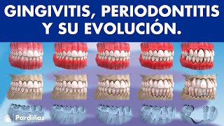 Gingivitis y periodontitis  Avance y evolución  Encías sangrantes © [upl. by Karen752]