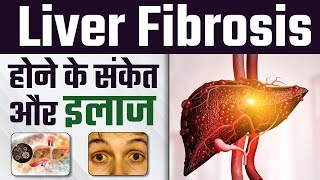 Liver Fibrosis होने का क्या कारण है  Liver Fibrosis होने के संकेत और इलाज  SRIAAS [upl. by Naus]