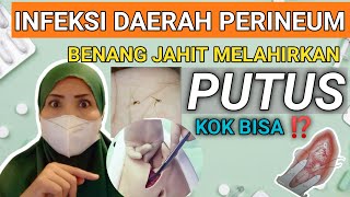 INFEKSI LUKA PERINEUM BISA MEMBUAT BENANG JAHIT TERLEPAS [upl. by Bennink]