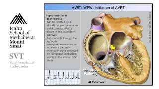 Supra Ventricular Tachycardia [upl. by Iznekcam]