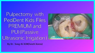 Pulpectomy with PediDent Kids Files PREMIUM and PUIPassive Ultrasonic Irrigation [upl. by Adnowal654]