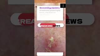 Tirbanibulin FDAApproved Breakthrough for Actinic Keratosis Treatment [upl. by Gypsy268]