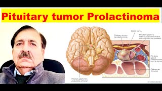 Prolactinoma Signs Symptoms diagnosis and Treatment Lectures by Dr Alamzeb [upl. by Balling]