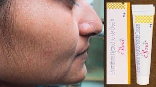 Eflora Cream for Facial Hair Removal  Eflora cream uses in Hindi [upl. by Haropizt]