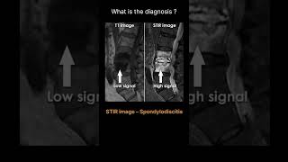 STIR image – Spondylodiscitis Quiz 16 radiologychannel007 [upl. by Aicul]