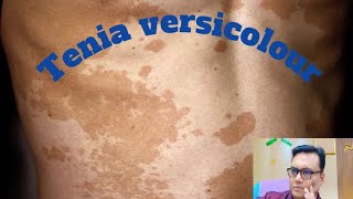 Tinea versicolour treatment Tinea versicolour causes fungal [upl. by Ekusuy]