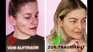 ❗️ In NUR 3 Monaten zur TRAUMHAUT  HEFTIGES Ergebnis ❗️ Microneedling Vorher Nachher Diana Delo [upl. by Lemon]