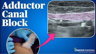 Adductor Canal Block 2024 update [upl. by Barrett]