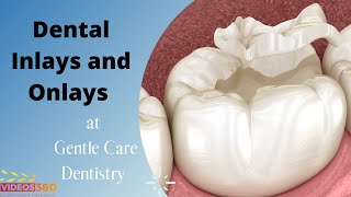 Dental Inlays and Onlays explained by Dr Brianne Luu [upl. by Ednargel588]