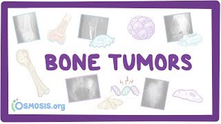 Bone tumors  causes symptoms diagnosis treatment pathology [upl. by Kyle]