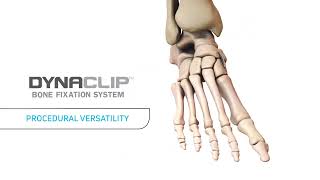 DynaClip® Bone Fixation System Animation [upl. by Enaillil634]