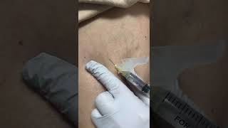 Spider Vein Treatment with Sclerotherapy [upl. by Ehsom]