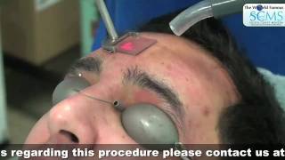 Acne Laser Therapy [upl. by Fullerton]