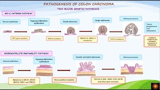 Pathogenesis of colorectal carcinoma  DrVShanthi [upl. by Pacificia]