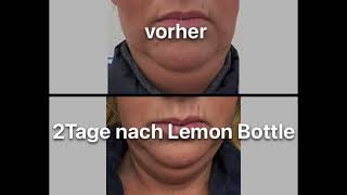 🍋LEMON BOTTLE  Doppelkinn bei LIFTNESS The Beauty Expert in Essen [upl. by Quartus]