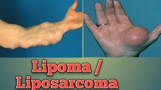 Lipoma  Liposarcoma Cancer Pathology Oncology Cancer [upl. by Steiner103]