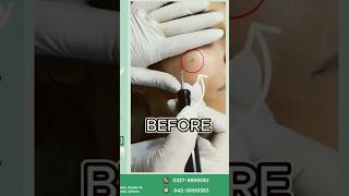 Electrocautery for Viral Warts Quick amp Effective Wart Removal enhancebydrwajieha [upl. by Eversole]