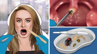 ASMR Remove The Fly amp Tonsil Stone From Adeles Throat [upl. by Goth]