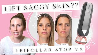 Skin Tightening At Home Tripollar STOP VX REVIEW  Does At Home Radio Frequency Treatment Work [upl. by Revell]