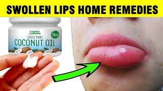 How To Treat SWOLLEN LIPS Naturally At Home [upl. by Vernice]