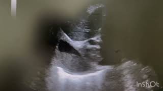 Ultrasound of Subdiaphragmatic abscess [upl. by Acirederf]