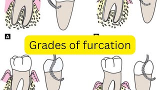 Grades of furcation involvement MADE EASY [upl. by Nedry]