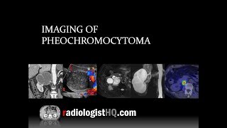 Imaging of Pheochromocytoma [upl. by Aiel]