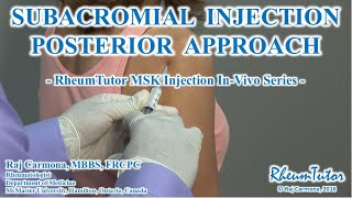 SUBACROMIAL INJECTION POSTERIOR APPROACH  InVivo Series [upl. by Cohlette]