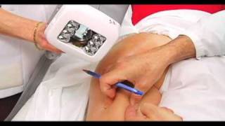 Dr Pierre Courchesne  Traitement de la cellulite  VelaShape [upl. by Earle]