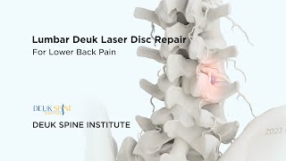 Lumbar Deuk Laser Disc Repair DLDR for Discogenic Back Pain  3D Animation [upl. by Aihsenrad]