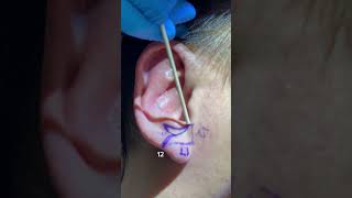 EAR REDUCTION SURGERY OTOPLASTY  DR TANVEER JANJUA  NEW JERSEY [upl. by Bendix]