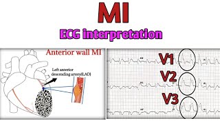 Myocardial infraction on ECG leadsAnterior wall MIinferior wall MIlateral wall MIPosterior MI [upl. by Aicertal]