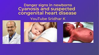 Cyanosis in a baby Suspected congenital heart disease Dr Sridhar K [upl. by Byrn371]