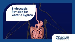 Endoscopic Revision for Gastric Bypass 3D Animation [upl. by Ewall]