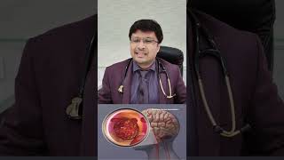 लकवे के मरिजो Stroke patients THROMBOLYSIS and its role [upl. by Cnahc]