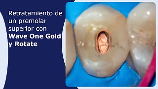 Retratamiento de un premolar superior con Wave One Gold y Rotate [upl. by Akired541]