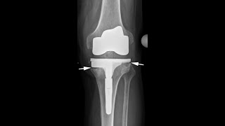 Die schmerzhafte Knieprothese  Diagnostik und Behandlungsoptionen [upl. by Hammer124]