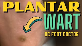 Plantar Wart Verruca Plantaris [upl. by Audette833]