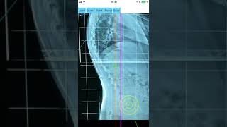 How to measure with Sagittal Balance App iOS [upl. by Donough569]