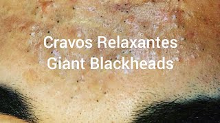 Espremendo Cravos e Espinhas Relaxante  Giant Blackheads  Cravos e Espinhas Gigantescas [upl. by Loseff]