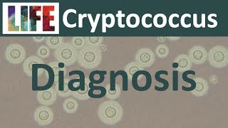 Diagnosing cryptococcal meningitis [upl. by Witty]