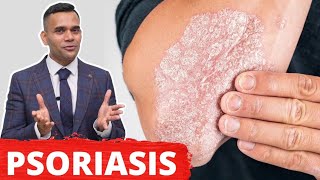 Psoriasis Treatment  The Best 2 Remedies For Psoriasis [upl. by Eelanej]