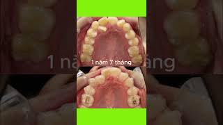 Niềng răng trong 19 tháng shorts niengrang braces [upl. by Aeki]